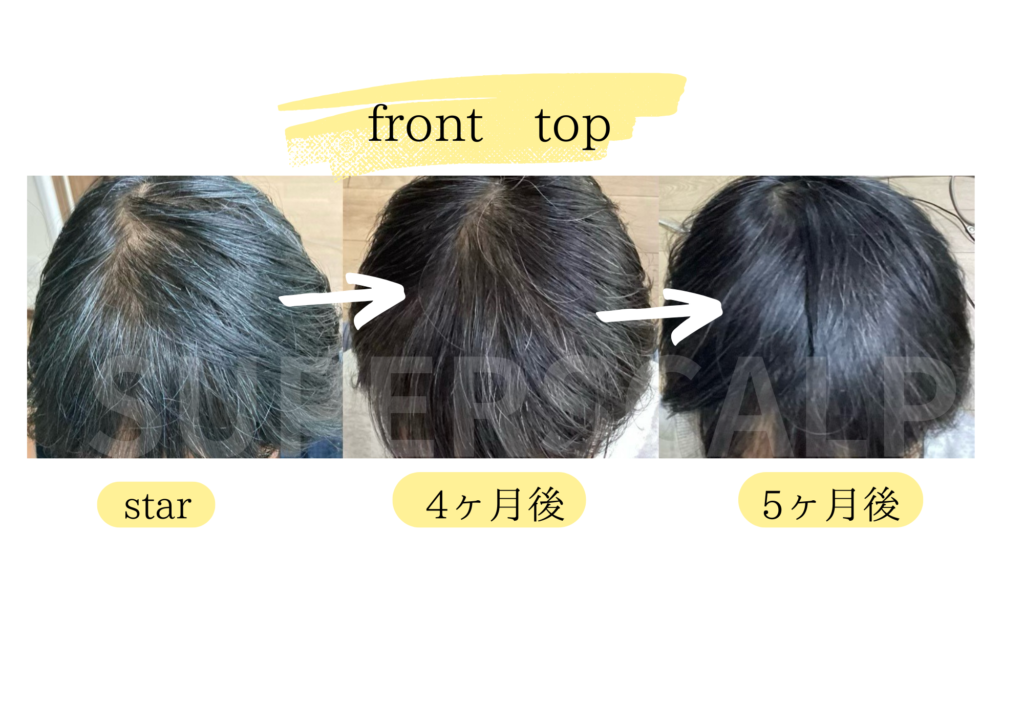 40代女性発毛経過　5ヶ月後