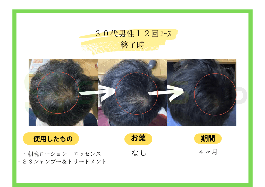 30代男性12回発毛コース症例