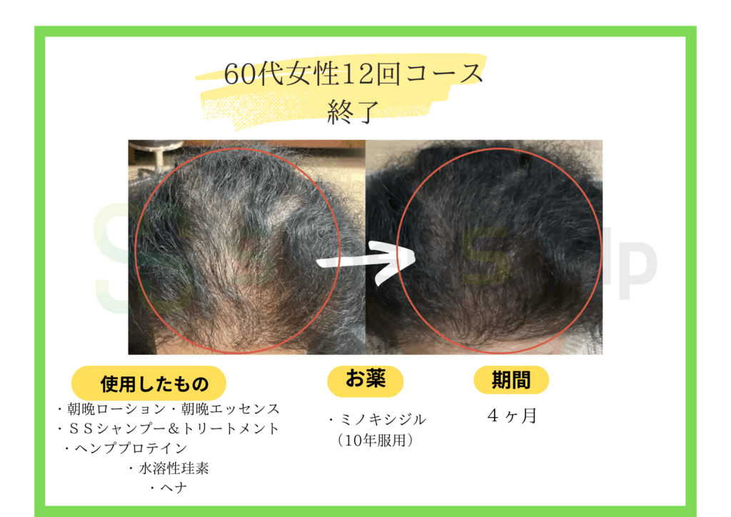 60代女性12発毛回コース症例