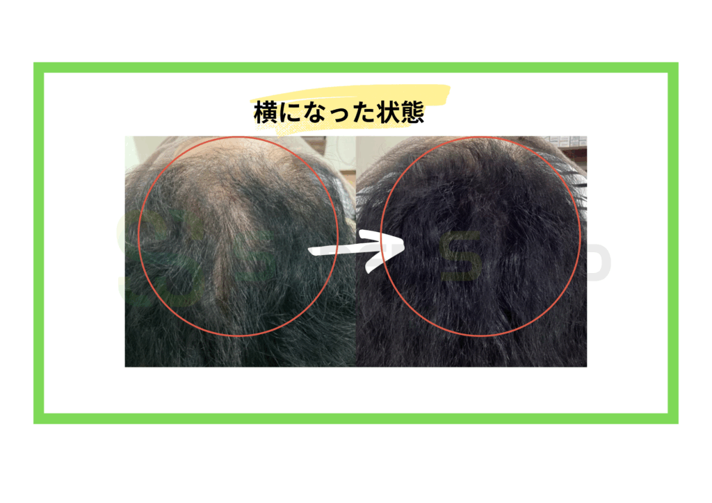60代女性12回発毛コース症例